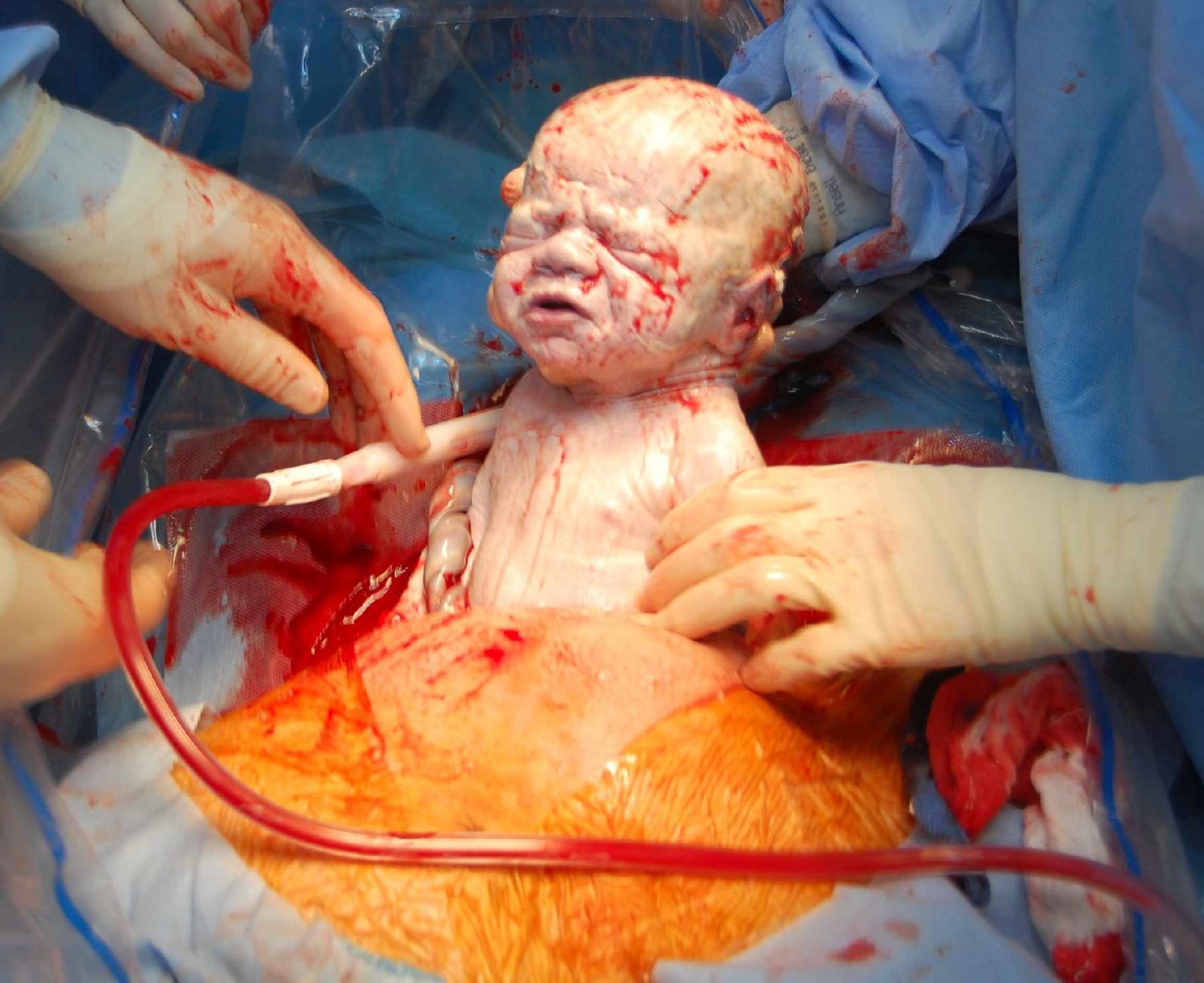 A child being born through a C-section