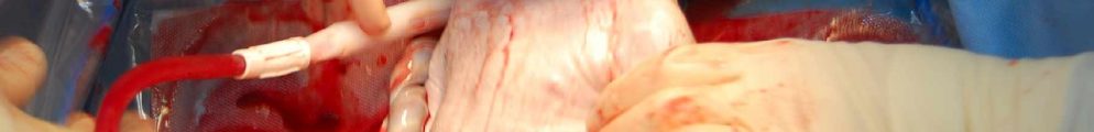 A child being born through a C-section